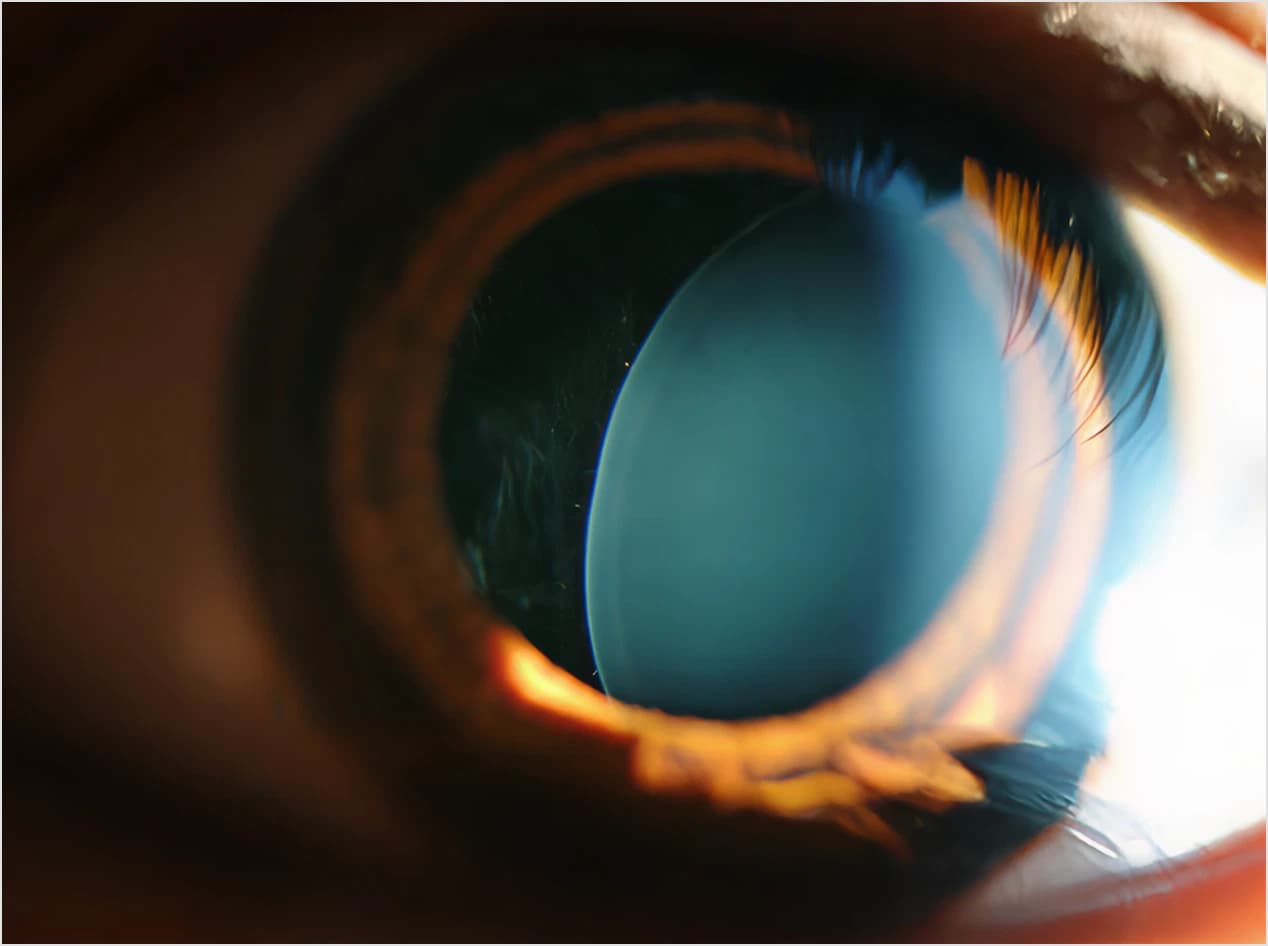 외상성 백내장 · 수정체탈구