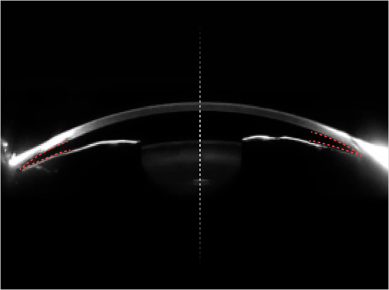 고도근시 혹은 전방이 얕은 백내장