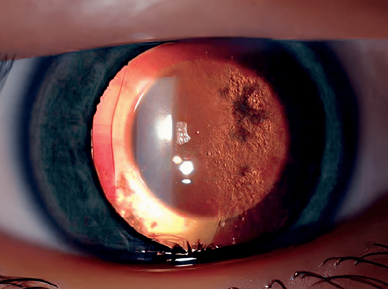 렌즈삽입술 후 백내장