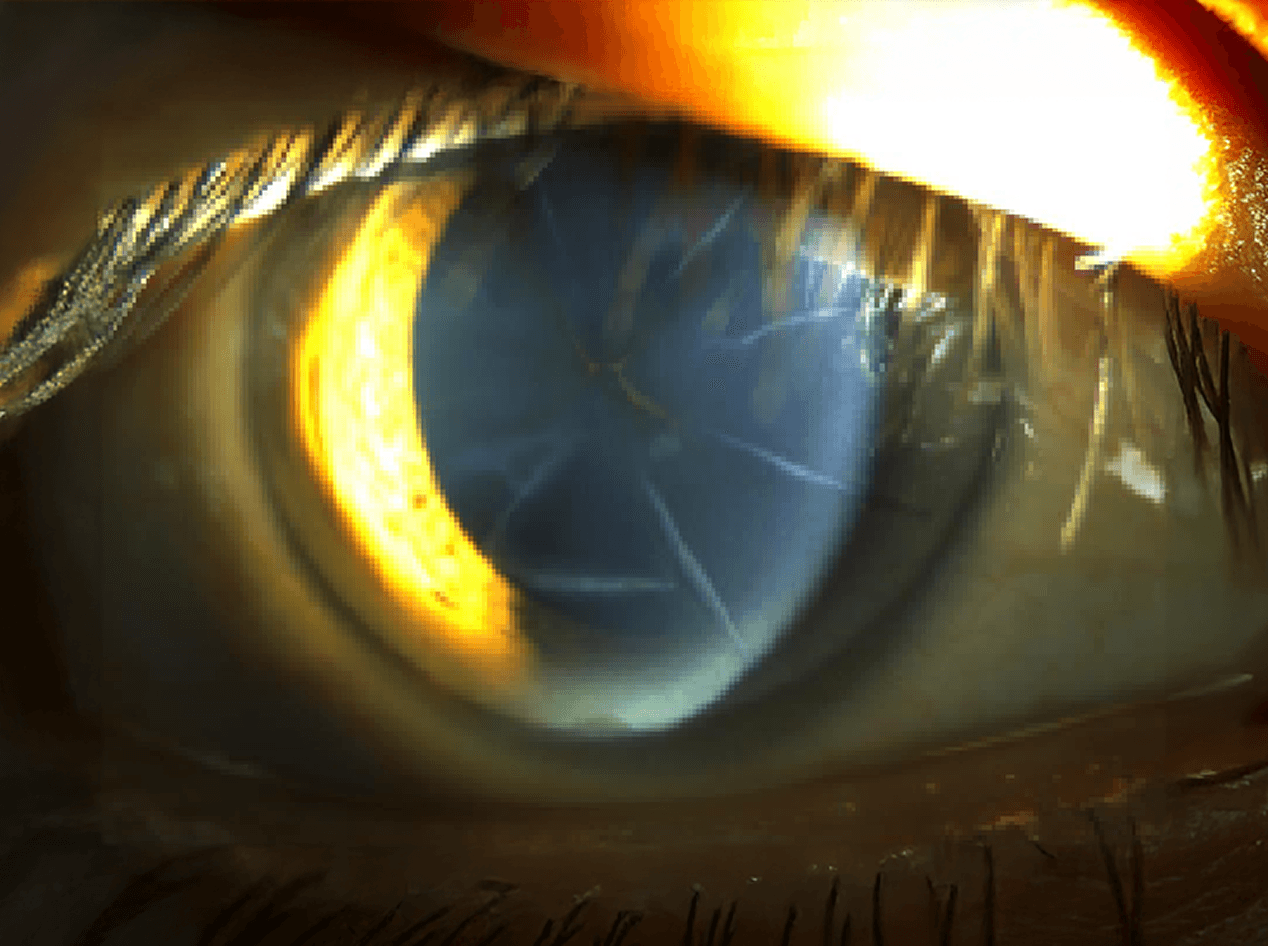 방사상 각막절개술 후 백내장