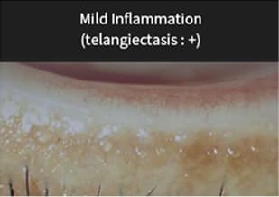 Mild Inflammation