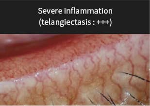 Servere Inflammation