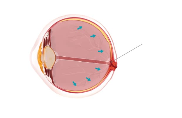 녹내장이 있는 눈