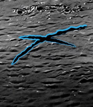 렌티큘이 제대로 제거되지 않을 경우 부정난시등을 유발