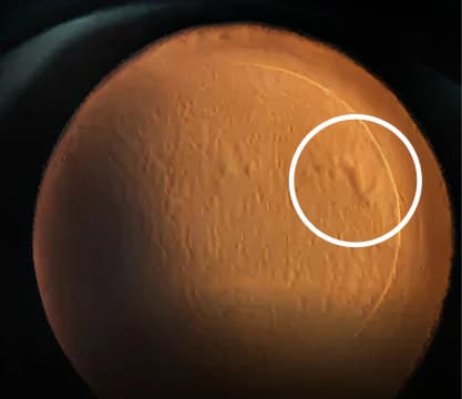 타 교정술 실질 박리 후