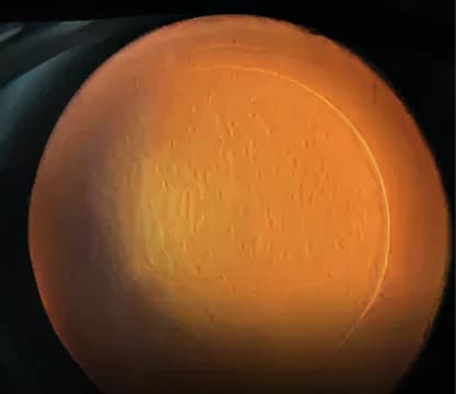 스마일 프로 실질 박리 후