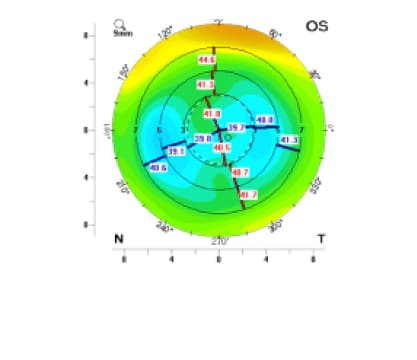 좌안 | 타사 시력교정술