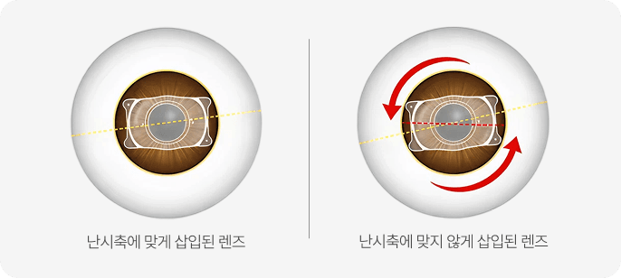 0.1˚의 미세한 난시축까지 교정