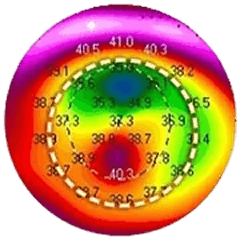 각막융기 및 부정난시