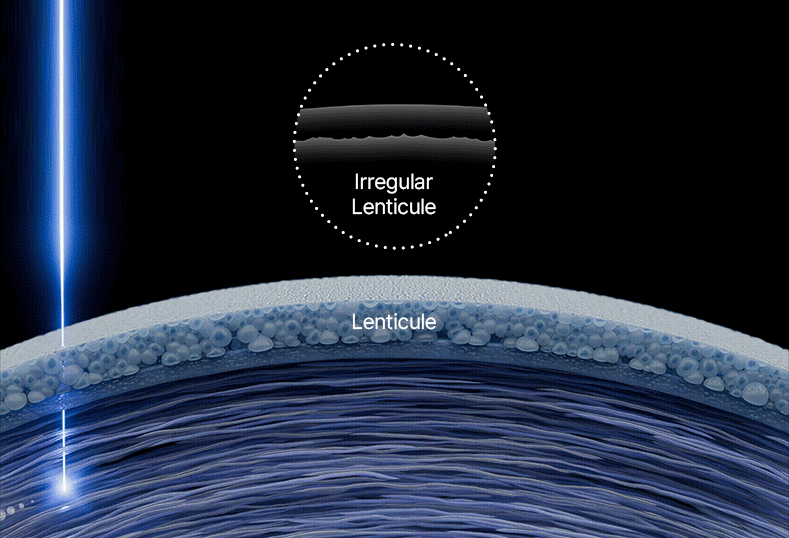 스마일 라식 25초