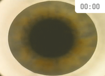 스마일라식 Visumax 500