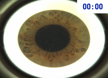 스마일라식 Visumax 800